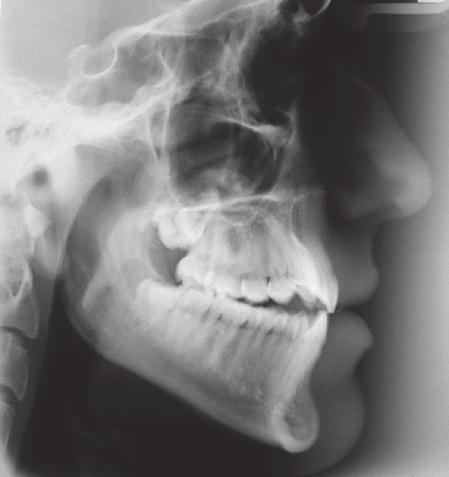 Rizzatto et al WORLD JOURNAL OF ORTHODONTICS Fig 2a Initial panoramic radiograph.