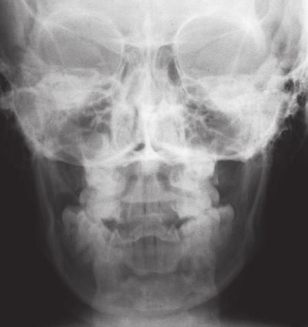 Fig 2c Initial frontal cephalogram showing a deviation of the mandible to the right and hinting at a transverse maxillary deficiency.