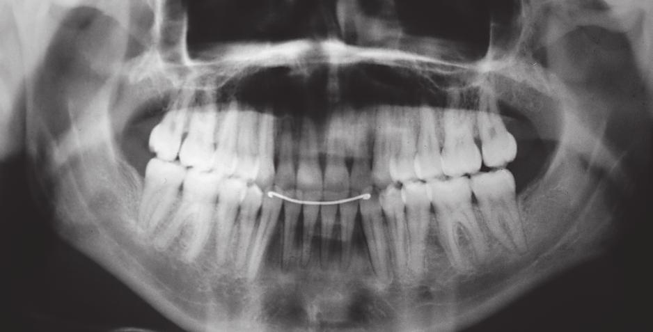 (d) Final frontal cephalogram revealing an adequate transverse relationship between maxilla and mandible.