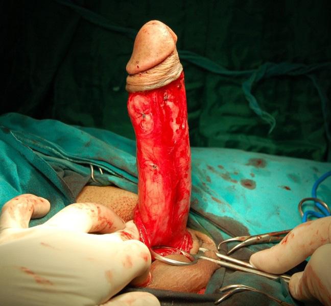 Figure 6. Artificial erection test at the end of the procedure. Figure 7. Artificial erection test at the end of the procedure confirms the penile straightening.