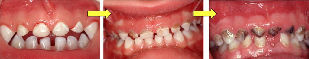 Early Childhood Caries (ECC) ECC is a chronic, highly infectious, easily transmittable disease, which can progress rapidly, and when left untreated, may result in