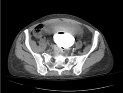 Urology consult was made with initial diagnosis of resolving hematoma of the bladder wall with recommendation for continued irrigation and eventual cystoscopy.