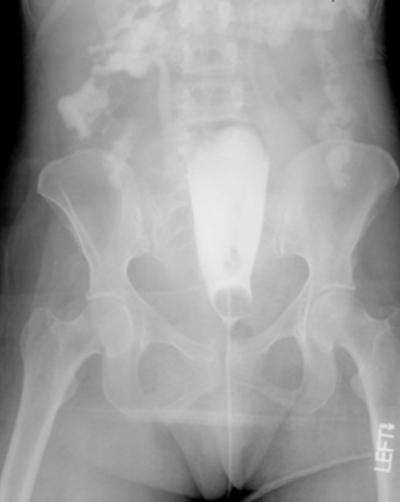 Note the right superior and inferior pubic rami fractures.