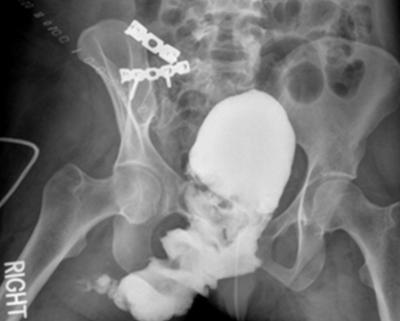 Repeat pelvic x-rays showed movement of the pubic rami and need for a second operative approach to repair.