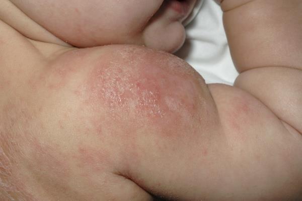 Clinical features of Atopic Eczema In acute stage of atopic