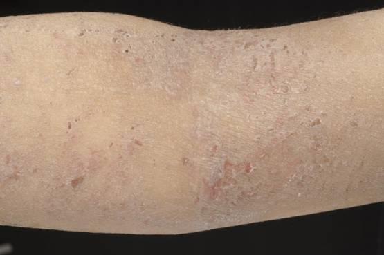 Vesiculation Excoriation In chronic eczema Lichenification