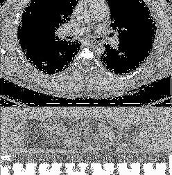 CXR and CT revealed a cylindrical density in the lumen of the left mainstem bronchus.