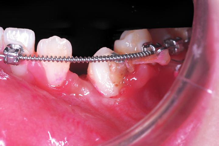 when the tooth was aligned, the root appears shorter than the contralateral canine, but the dilaceration is still present.