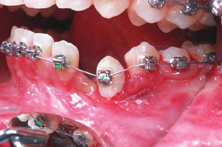 : At sixteen months (6M) into treatment, a torquing spring was attached to the archwire to apply lingual root torque to tooth #. increased from to 9.