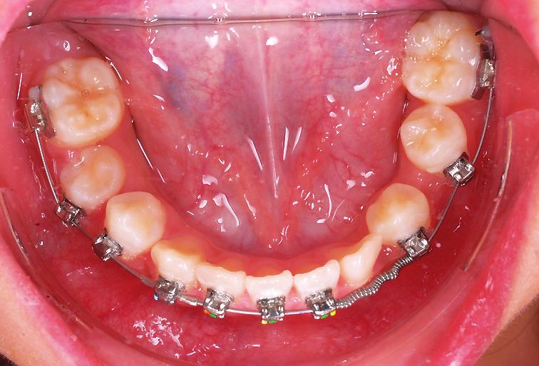 IJOI 6 iaoi CASE REPORT Specific Objectives of Treatment Maxilla (all three planes): A - P: Allow for normal growth Vertical: Allow for normal growth Transverse: Maintain Mandible (all three planes):
