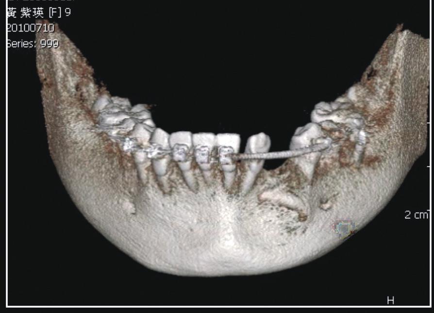 An elastomeric power chain, anchored by the OBS, was used to retract tooth #, to help open space for the impaction (Fig. ).