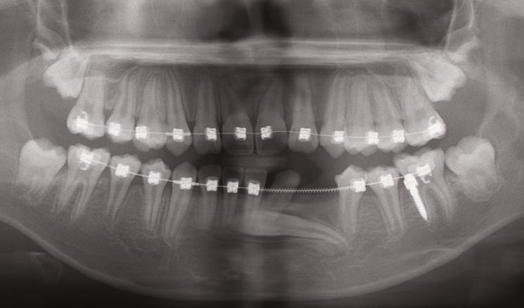 -in CuNiTi wire was engaged with an open coil spring between teeth # 9 to to open space, and tooth #, was bonded with a low torque bracket one month later.