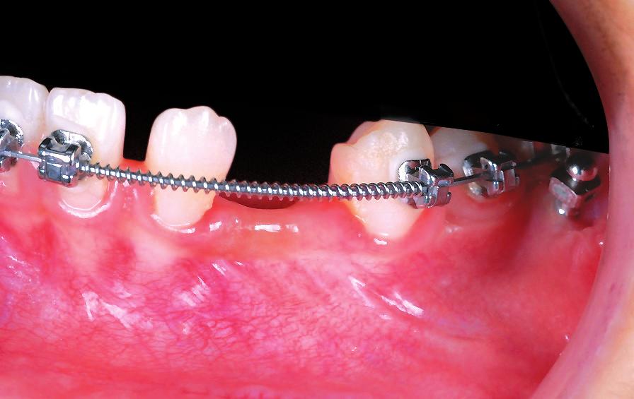: A xmm OBS with a rectangular hole through the head was inserted in the mandibular left buccal shelf, and a power chain from the OBS was used to retract tooth # along the