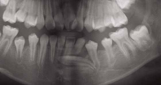 IJOI 6 iaoi CASE REPORT canines to the lower first molars to correct the Class ll relationship. An open bite in the area of teeth # and was noted.