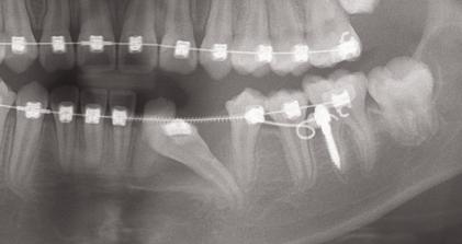: A progressive series of panoramic x-rays illustrate the uprighting of the impaction over an month period compared to pre-treatment (M).