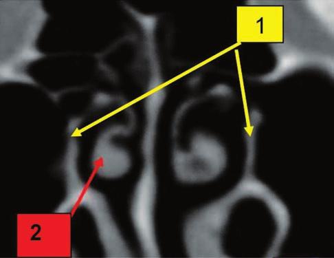 Paradoxical curvature of the middle turbinate Table 5 Case distribution according to the presence of the uncinate process pneumatization Cranio-facial CT scan No.