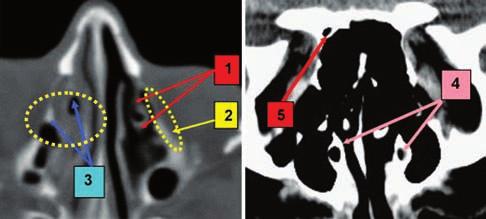 144 Romanian Journal of Rhinology, Vol. 2, No. 7, July - September 2012 Figure 9 Paranasal sinuses CT scan: 1. pneumatised left uncinate process, adherent to the lamina papyracea; 2.