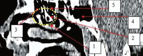 pneumatization of the clinoid process Figure 10 Paranasal sinuses CT scan, left sagittal reconstruction: 1. trilocular concha bullosa; 2. pneumatization of the uncinate process, elongated; 3.