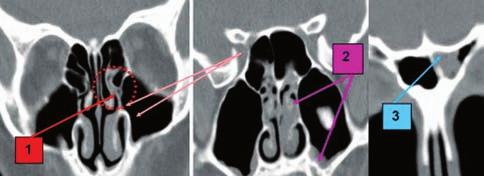 ethmoid bulla Figure 16 Paranasal sinuses CT scan, bone window, consecutive coronal slices: 1.