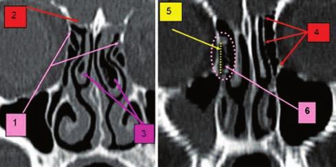 146 Romanian Journal of Rhinology, Vol. 2, No. 7, July - September 2012 Figure 18 Paranasal sinuses CT scan: 1. bilateral uncinateprocess insertion into lamina papyracea; 2. skull base; 3.