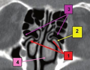 bilateral curved uncinate process, medialized, inserted superior into the ethmoid bulla; 2. left narrowed uncinate sulcus; 3. hypertrophic, deformed ethmoid bulla; 4.