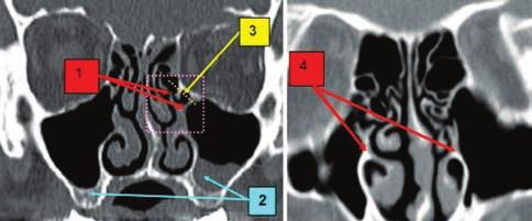 pathologic process in the maxillary sinuses; 3. lamina papyracea; 4. bilateral bifid uncinate process Figure 24 Paranasal sinuses CT scan, bone window, axial slices: 1.