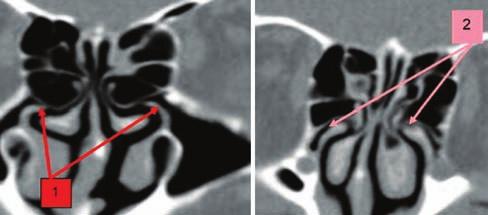 Baldea et al Anatomical variants of the uncinate process CT scan imaging study 147 Figure 25 Paranasal sinuses CT scan, coronal bone reconstruction. Free margin deformity of the uncinate process: 1.