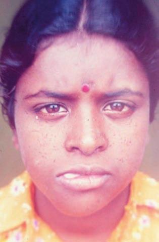 Ekstraoralna fotografija s prikazom kožnih lezija na licu Figure 2 Extraoral photograph showing skin lesions on the face. Slika 3.