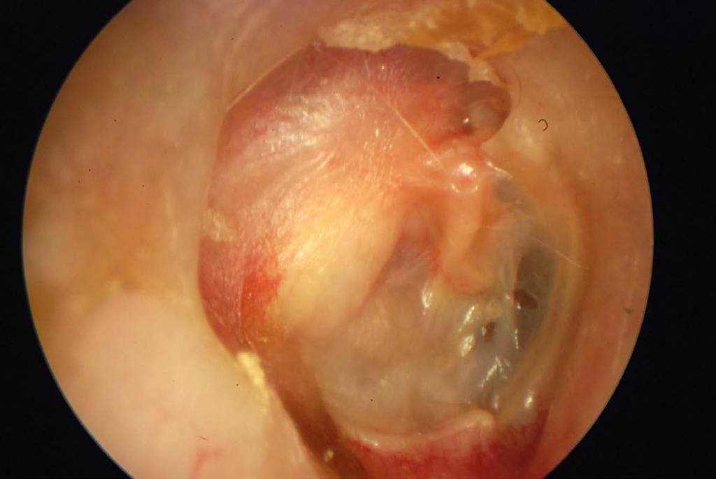 Atticotomy with autograft cartlage EAC wall repair, undertaken for limited