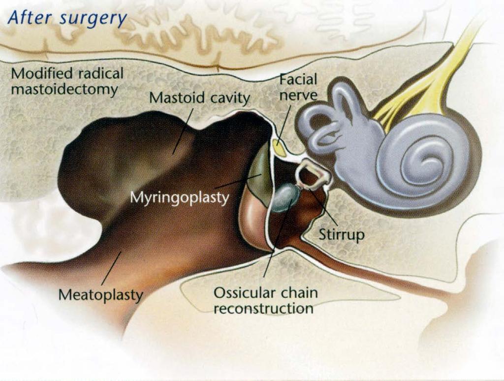 Plan of an open cavity (CWD: canal wall down surgery).