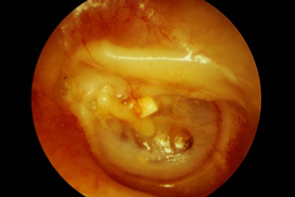 Atticotomy, repaired with an autograft cartilage onlay technique.