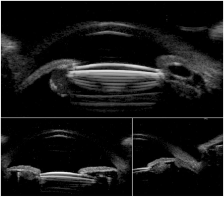 1 Slit-lamp photographs of anterior segment before neodymium: YAG laser peripheral iridotomy.