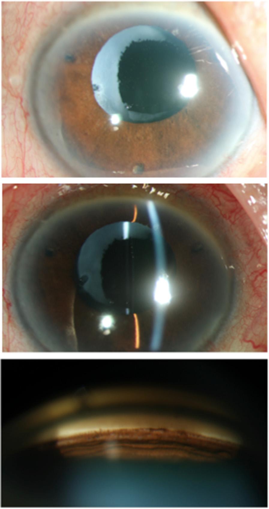 Suwan et al. BMC Ophthalmology (2016) 16:91 Page 3 of 6 Fig. 4 Before laser treatment. a Shallow both central and peripheral anterior chamber. b, c Gonioscopy shows peripheral anterior synechiae.
