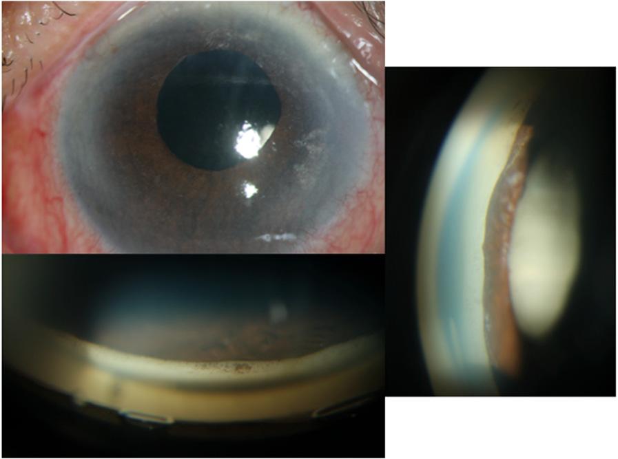 Nd: YAG laser iridotomy was performed at 2, 6 and 10 o clock. a, b Immediately after laser surgery the central anterior chamber was deepened. c Anterior chamber angle was opened 3.25 mm).