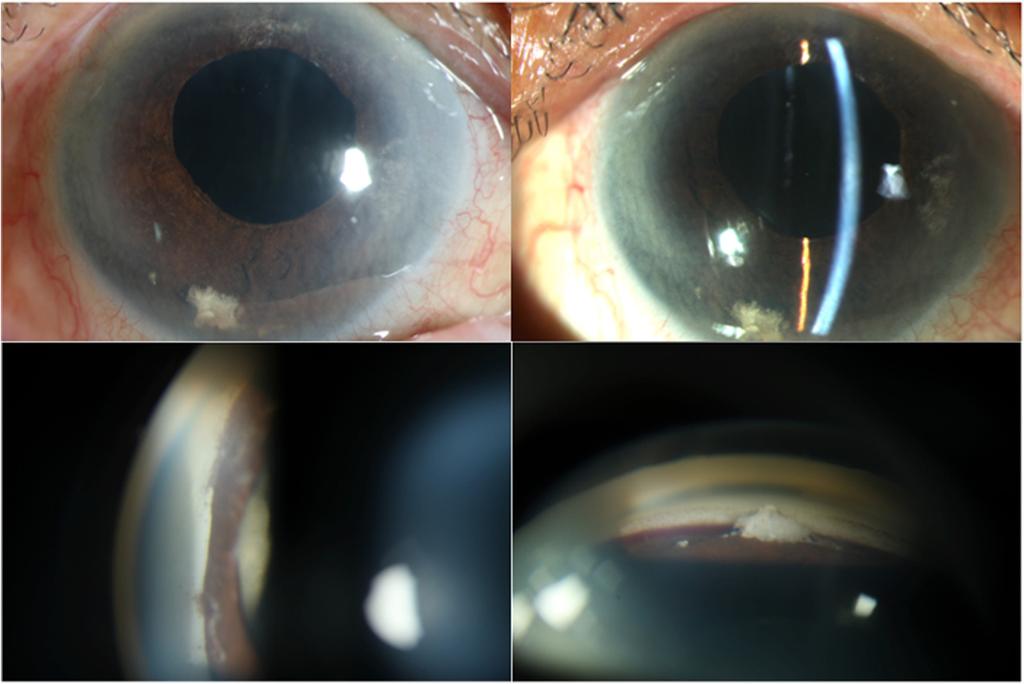 b After laser treatment, hyperechoic content moving into anterior chamber through iridotomised hole with deepening of anterior chamber Fig.