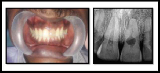 Esthetic correction of 21 was achieved with walking bleach technique (Using sodium perborate and distilled
