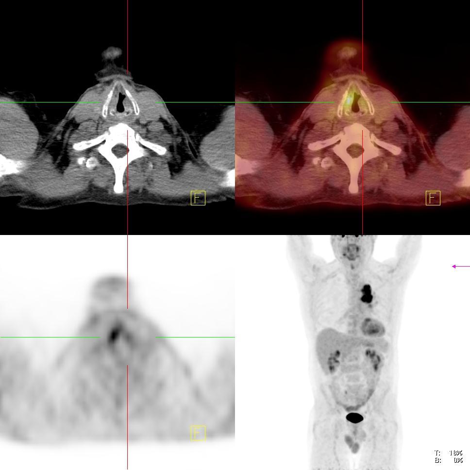 Likely T2 NSCLC on conventional staging Left vocal cord palsy indicates
