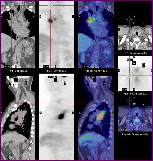 PET-CT has been shown to be substantially more sensitive and specific in the detection and characterization of metastases to