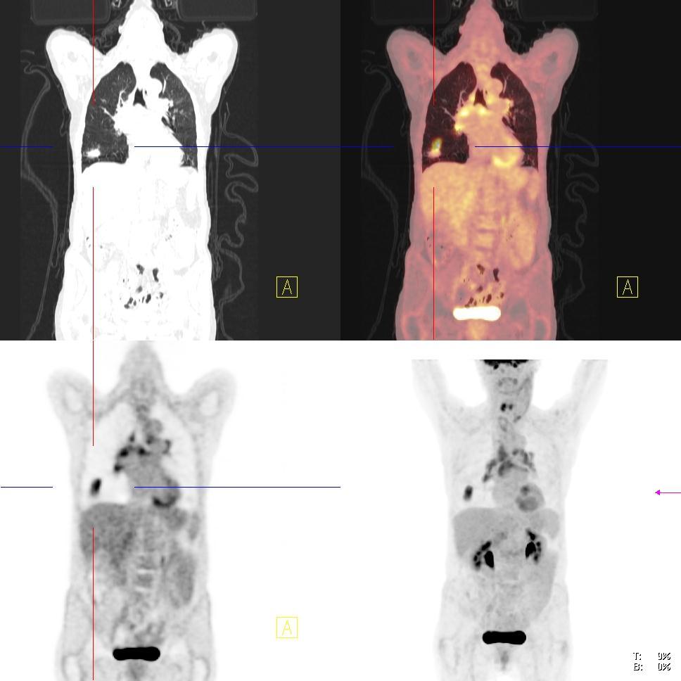FDG PET/CT - N Staging Limitations The main limitations of FDG-PET for N staging false-negative - microscopic lymph node involvement - low tumour