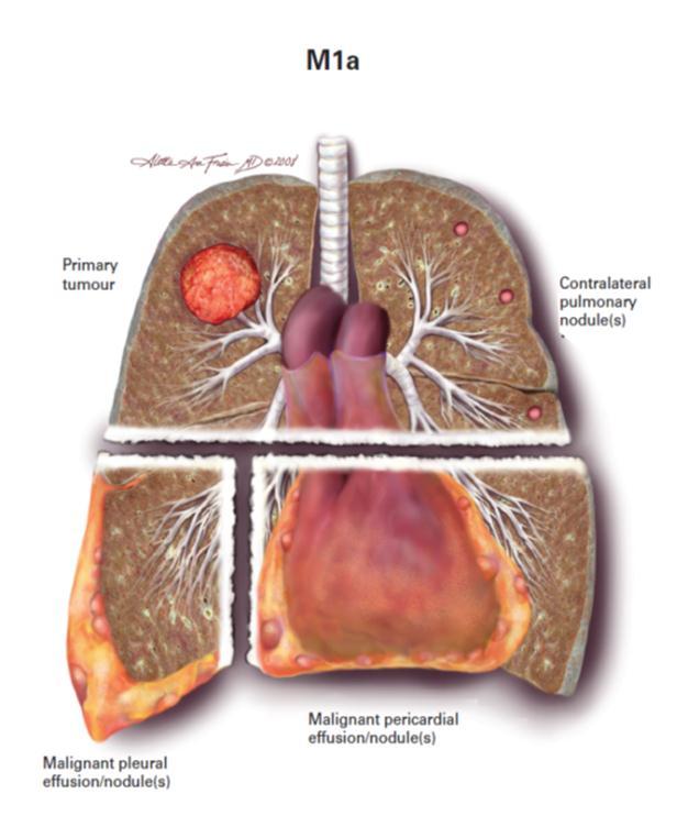 STAGING OF LUNG CANCER M STAGE M1a (Intra-thoracic Metastases) Malignant