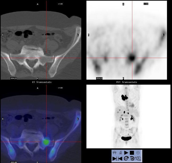 STAGING OF LUNG CANCER M STAGE FDG PET/CT detected occult extrathoracic metastases in upto 24% of patients selected for curative resection Lung Cancer Upstaged from M0 to M1b Bony, Adrenal and Liver