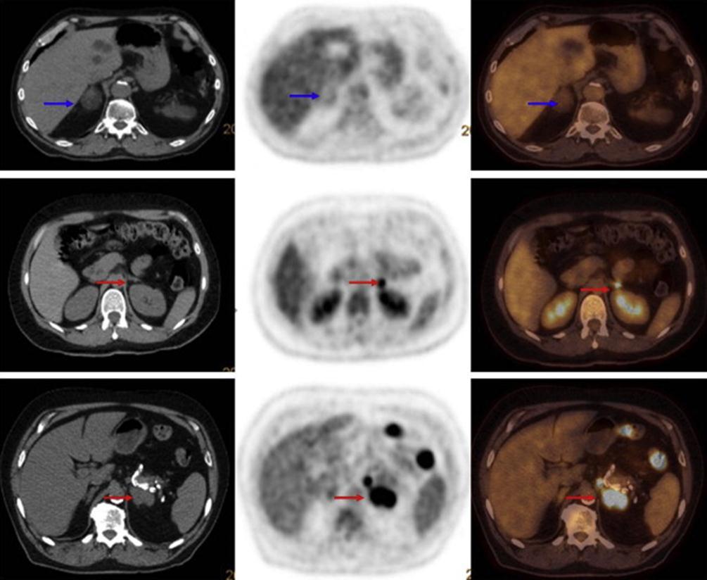 ADRENAL METASTASES Right adrenal adenoma Adrenal metastases are detected in upto 20% of patients with NSCLC. CT has a reported sensitivity, specificity, and accuracy of 60%,80%,and77%, respectively.
