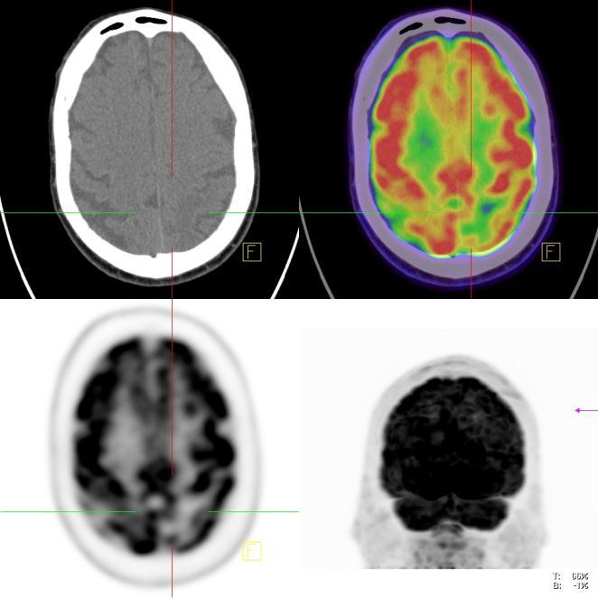 Contrast-enhanced CT is the most commonly performed procedure in search of brain