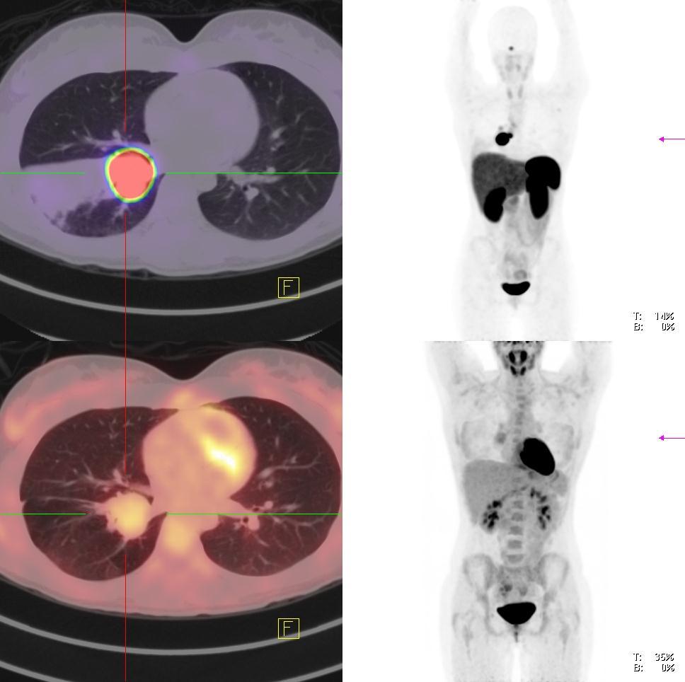 PET/CT STAGING OF LUNG CARCINOID Neuroendocrine tumours vary in differentiation