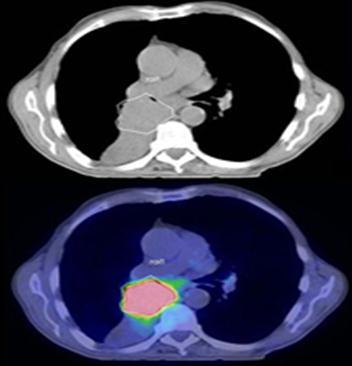 The primary tumour is very difficult to visualize on CT.
