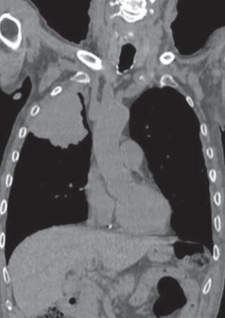 PET/CT also improves detection of subtle areas of invasion that may be occult on CT alone.