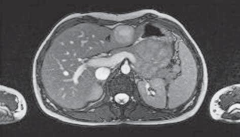 1a, b) revealed a tumorous ring-shaped lesion, in addition to prior CT-verified lesion, with a diameter of 42 mm on the right paravertebral side in the projection of the duodenum, which was confirmed