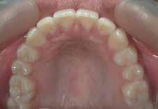 Unilateral molar