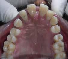 13B 13C Conclusion Most Orthodontists are skeptical about using a fixed functional appliance after the end of pubertal
