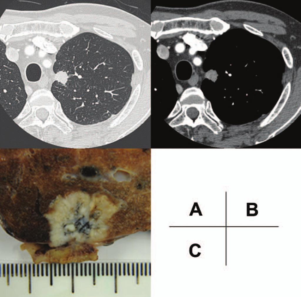 Watanabe et al. Journal of Thoracic Oncology Volume 8, Number 6, June 2013 FIGURE 1. A case of pt4 disease invading the mediastinal fat tissue.